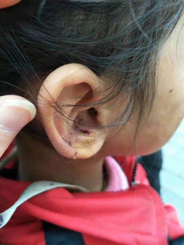 Bé gái 6 tuổi bị mẹ đẻ ngược đãi dã man khiến mặt đầy vết thương, tóc rụng thành mảng lớn